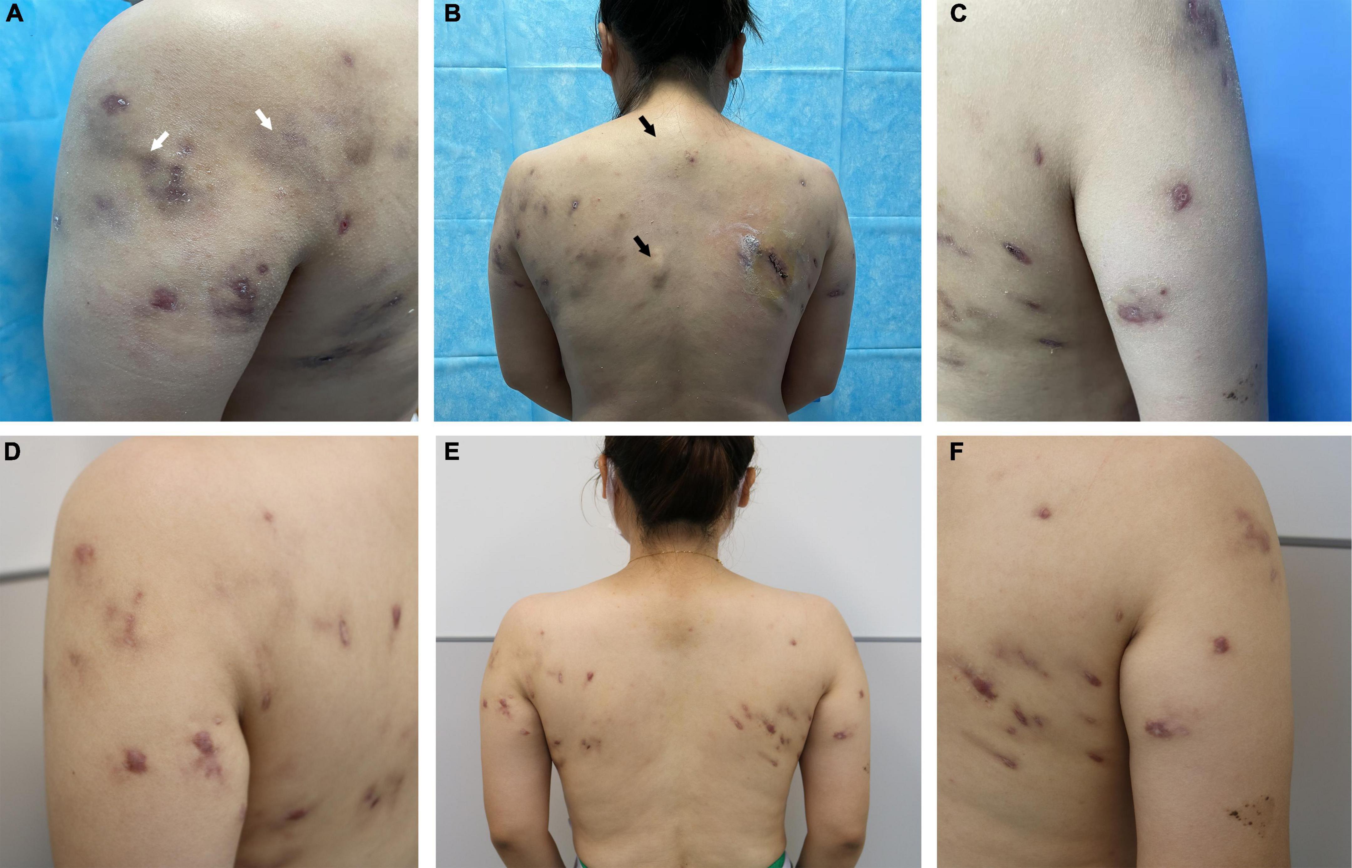 Case report: Subcutaneous Mycobacterium haemophilum infection in an immunocompetent patient after lipolysis injections